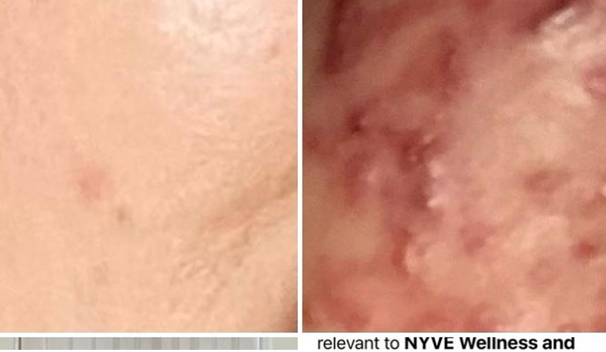 Acne: Causes, Types, and How Natural Support Can Make the Difference